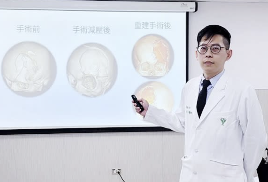 鄭鴻翔醫師說明 3D 顱骨重建新聞報導封面